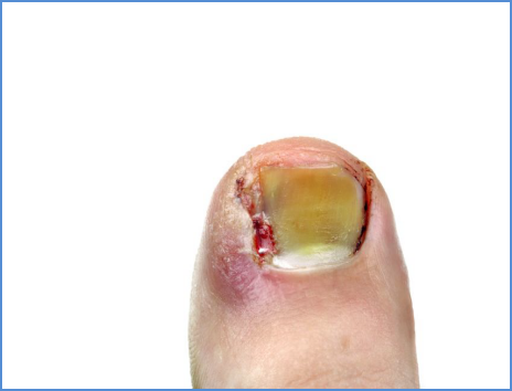 Ingrown Toenails - Unique Family Chiropractic & Wellness Centre