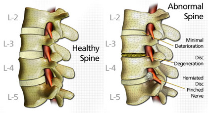 Degenerative Disc Disease  Spinal Decompression Livermore